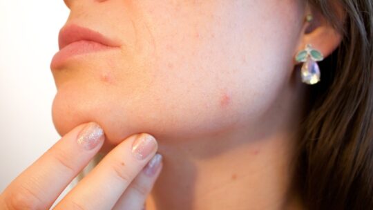 Les erreurs à éviter dans votre routine si vous avez de l’acné